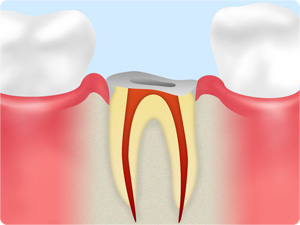 歯の根っこの部分が歯ぐきに埋まっている状態です。