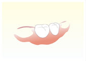 入れ歯・義歯の種類 バネのない入れ歯　自費治療